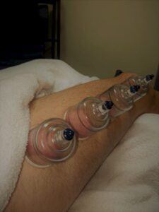 Myosynergy Balwyn massage & cupping